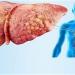 علامات الكبد الدهني التي قد تظهر على الجسم